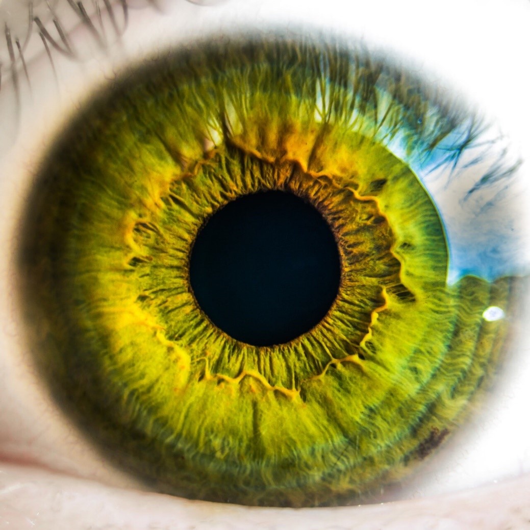 iridology Hypertension