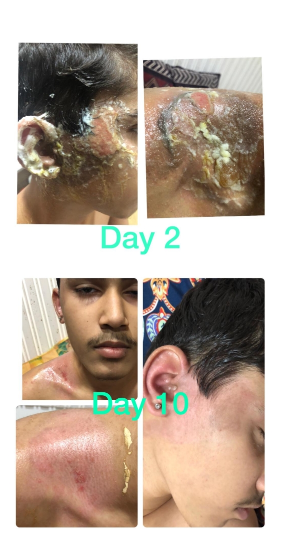 Healing Of Severe Burns Through Sujok Therapy & Electrohomeopathy : A Case Report